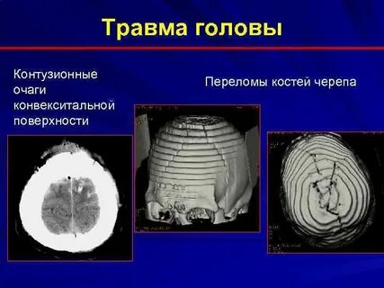 Конвекситальные борозды