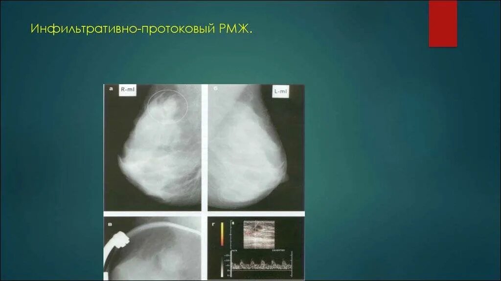 Симптом площадки при раке