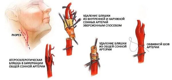 Бляшки в шейном отделе симптомы