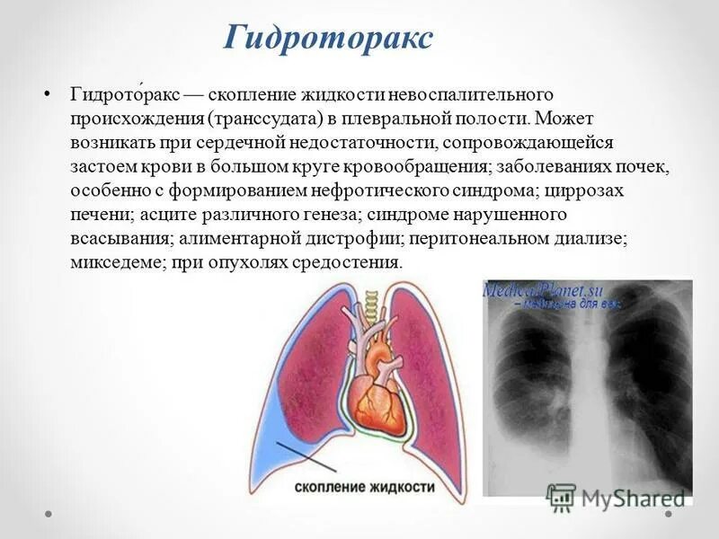 Скопление крови в плевральной полости