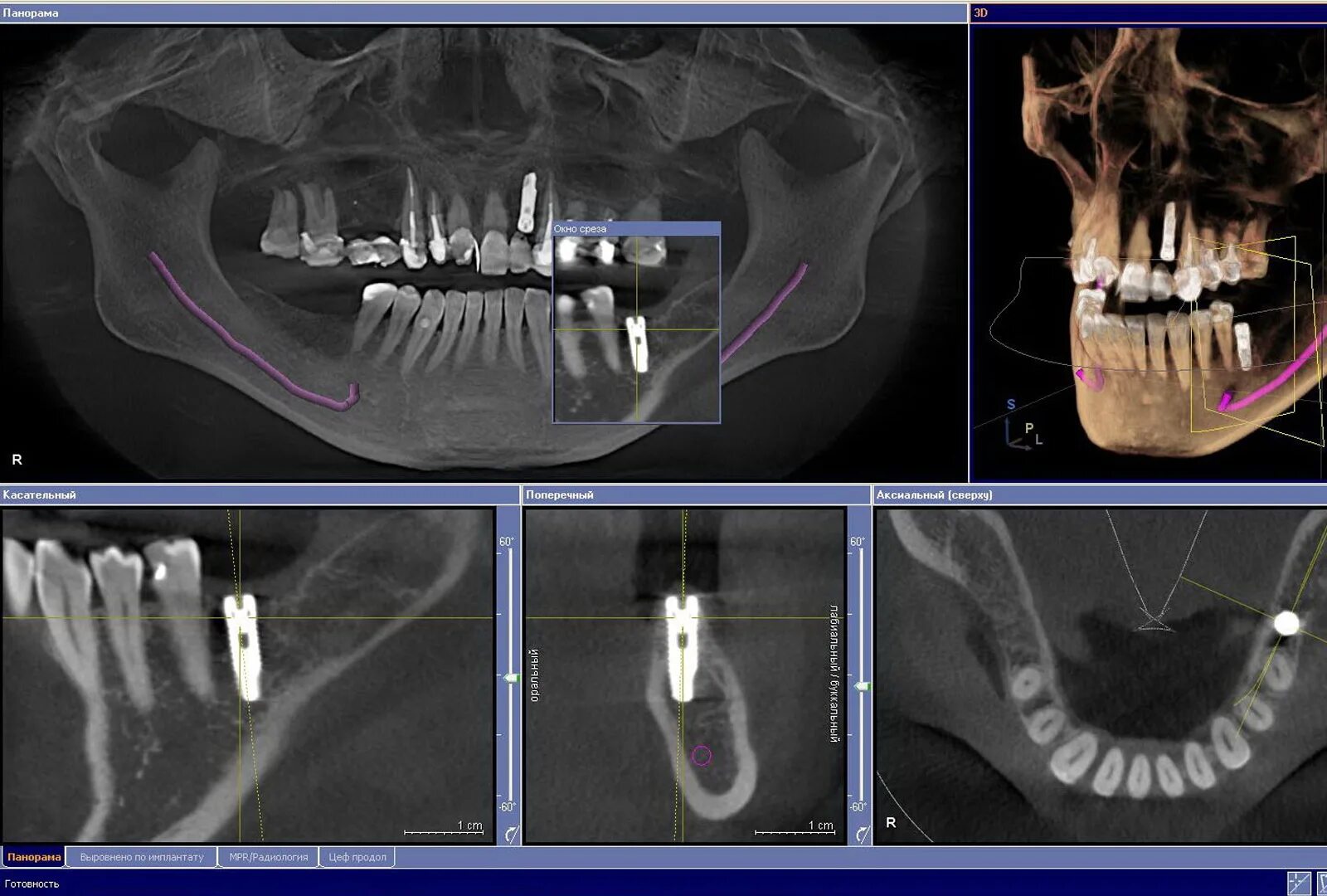 Где сделать кт зуба. Кт 3d верхней и нижней челюсти. Компьютерная томография челюсти снимок. Компьютерная томография зубов: 3d диагностика челюсти. Кт имплант верхняя челюсть.