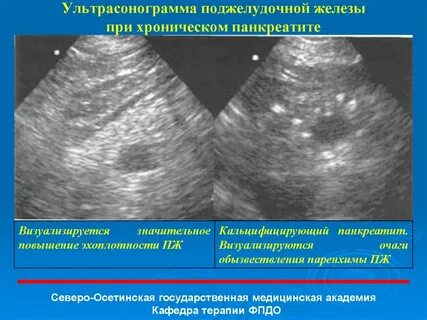 Кал при панкреатите
