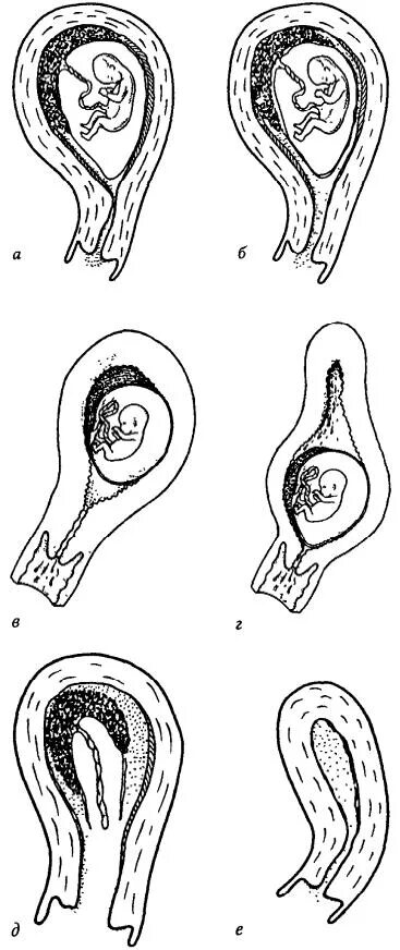 Матка сокращается после выкидыша. Угрожающий самопроизвольный выкидыш. Угрожающий неполный выкидыш. Матка сокращается после выкидыша. Плодное яйцо в 6 недель медикаментозное прерывание.