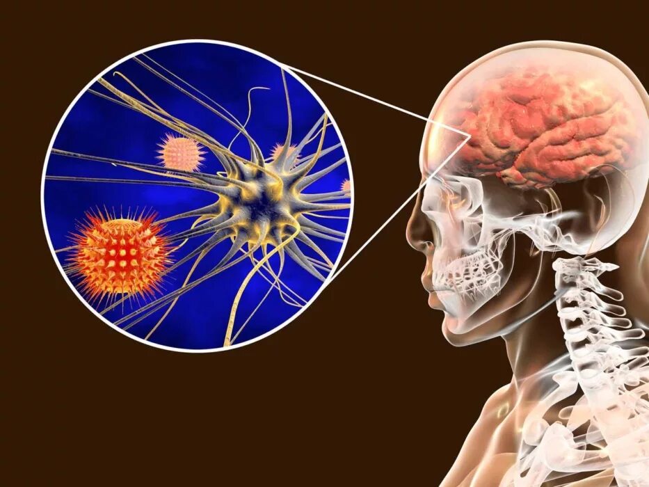 Бактериальный менингит-энцефалит. Менингит головного мозга. Туберкулезный менингит. Нервный туберкулез