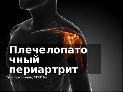 Плечелопаточный периартрит справа