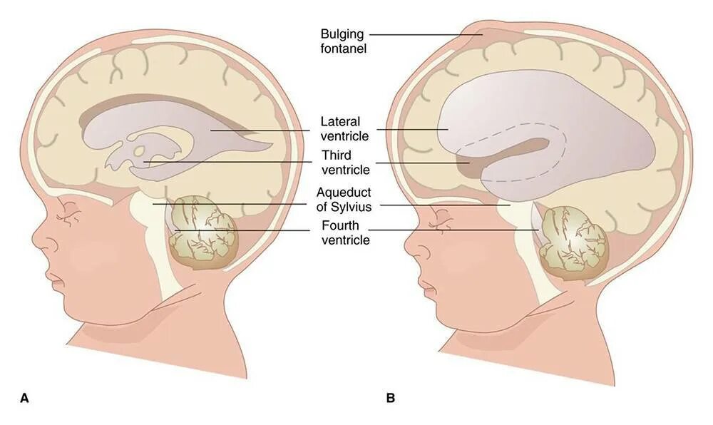 Изменения головного мозга у новорожденного. Желудочки головного мозга при гидроцефалии. Гидроэнцефалопатия головного мозга у новорожденного. Наружная гидроцефалия головного мозга у новорожденного. Гидроцефалия водянка головного мозга.