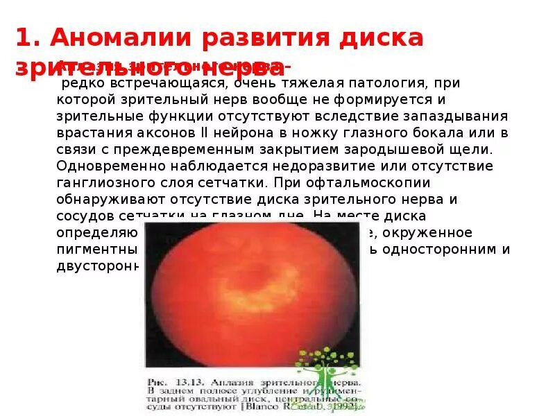 Аномалии зрительного нерва. Аномалии развития диска зрительного нерва. Врожденная аномалия диска зрительного нерва. Врожденная патология зрительного нерва.