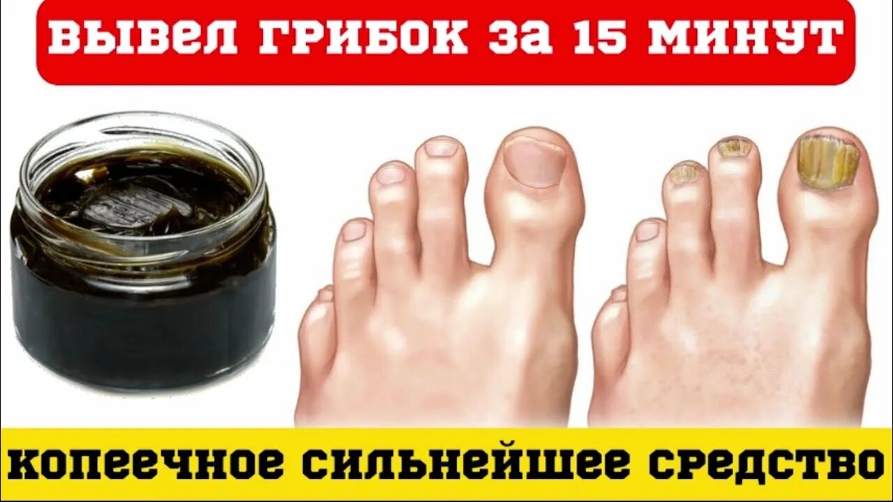 Это Выжигает Грибок Моментально! 2023 Еда по-настоящему Meal4real ВКонтакте