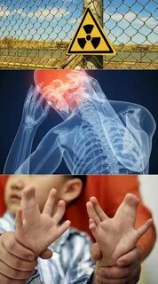 Болезни от радиации