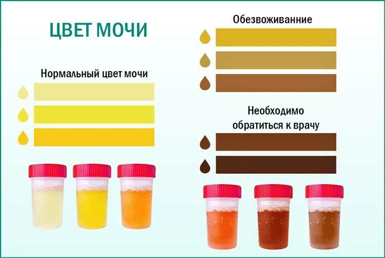 Почему моча зеленоватого цвета у женщин. Цвет мочи. нормальный цвет мочи. цвет мочи норма. моча аномального цвета.