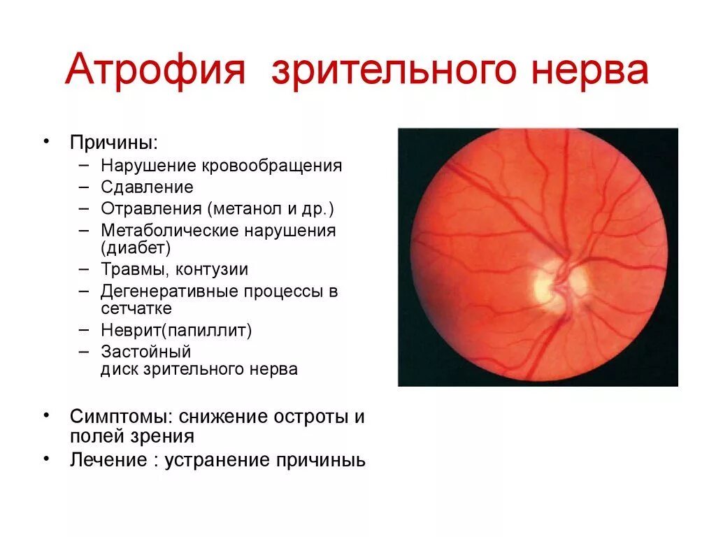 Место выхода зрительного нерва не воспринимающее лучей. Клинические признаки поражения зрительного нерва. Диск зрительного нерва при неврите. Диск зрительного нерва при атрофии. Поражение зрительного нерва причины.