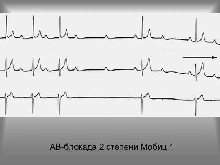 Блокады 2 степени армия. Атриовентрикулярная блокада Мобиц 1 ЭКГ. АВ блокада 2 степени Мобиц 1. АВ блокада 2 степени Мобиц 1 на ЭКГ. Блокада 2 степени ЭКГ Мобиц 2.