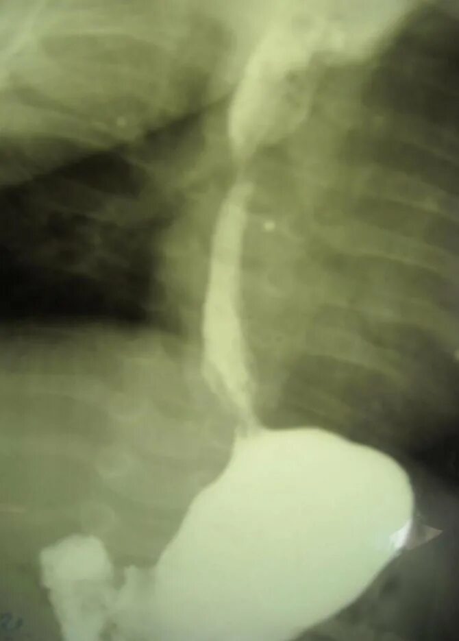 аксиальная хиатальная грыжа. аксиальная хиатальная грыжа пищевода. скользящая гпод рентген. грыжа диафрагмы пищевода рентген. параэзофагеальная грыжа пищеводного отверстия диафрагмы рентген.