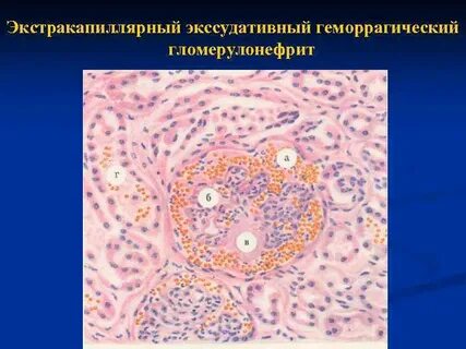 Геморрагический нефрит