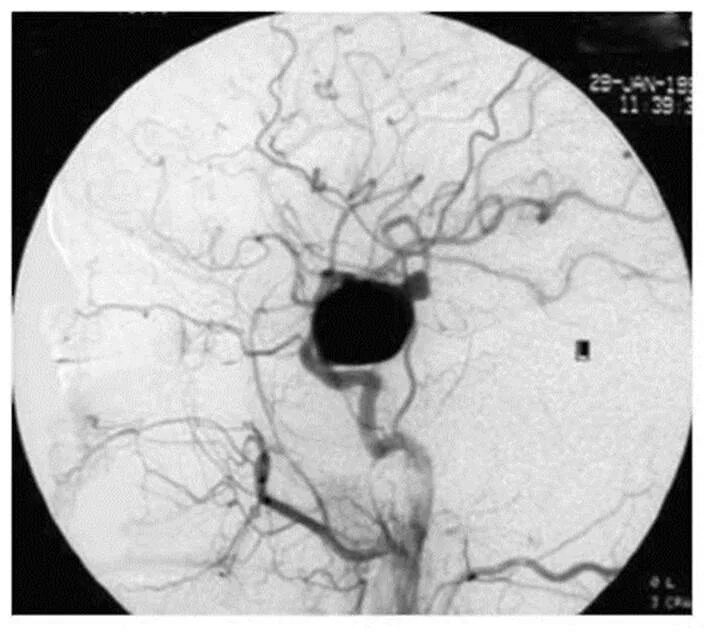Форум аневризма мозга. Аневризма м1 сегмента СМА. Аневризмы левой СМА ( сегмент м1). Аневризма сегмента левой ВСА. Фузиформная аневризма головного мозга.
