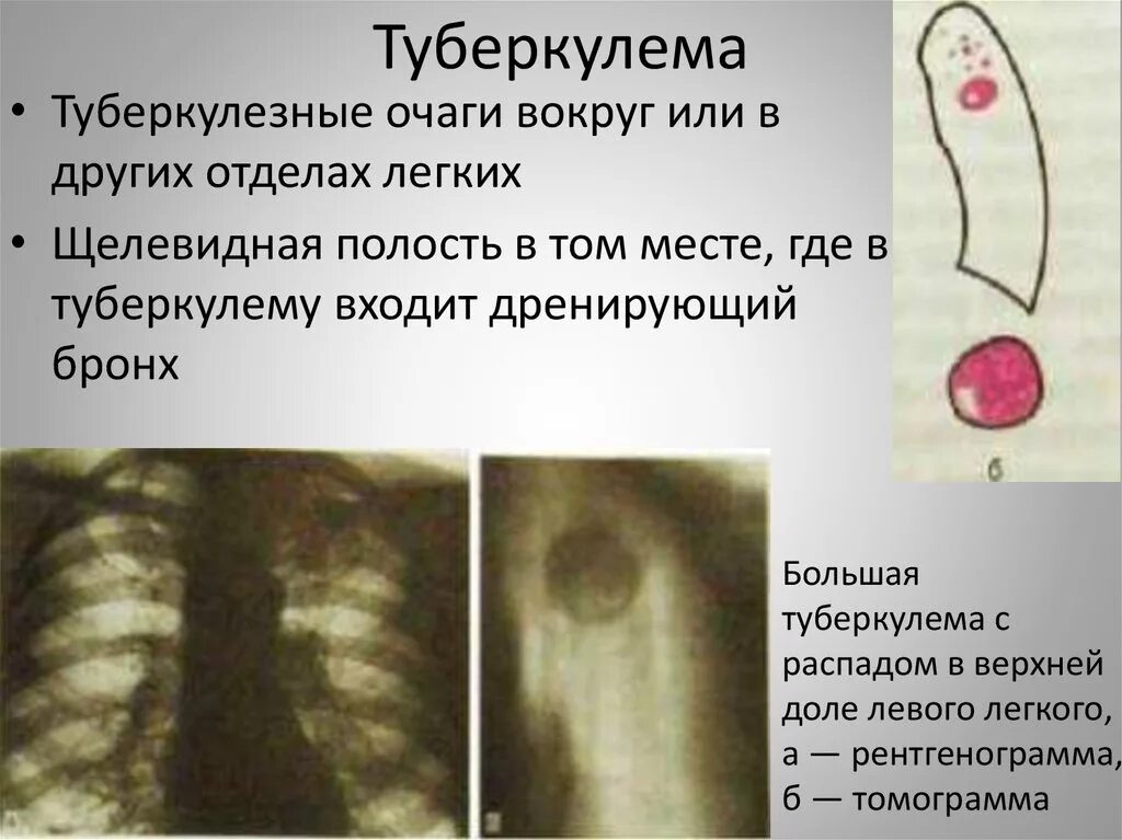 Туберкулема рентгенологические признаки. Туберкулема форма туберкулеза. Туберкулома это туберкулез. Конгломератные туберкулемы.