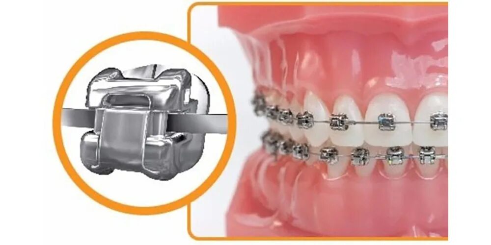 Крючки для брекетов. Стопор зажимной ортодонтическая. Крючки для брекетов. Брекеты межчелюстные эластики. Крючки на ортодонтические винты.