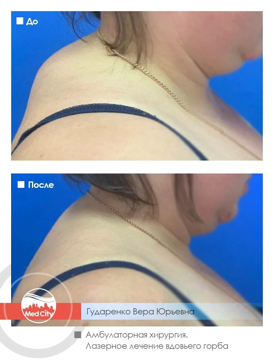 Вдовий горб причины возникновения у женщин. Вдовий горб кэмерон диаз. Операция по удалению холки. Лазерная липосакция вдовьего горба. Холка.