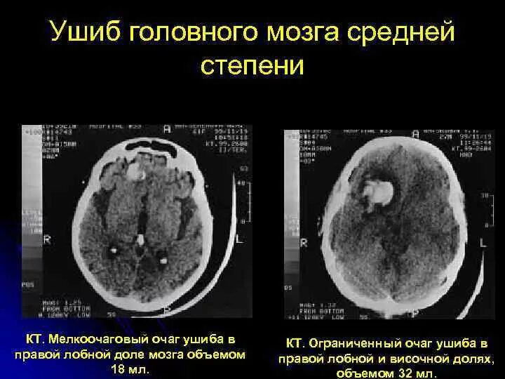 Сотрясение средней тяжести. Черепно мозговая травма кт и мрт. Ушиб головного мозга средней степени кт. Ушиб головного мозга средней степени тяжести кт. Ушиб головного мозга тяжелой степени тяжести кт.