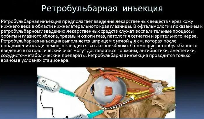 Интравитреальная инъекция. Ретробульбарная анестезия в офтальмологии. Парабульбарная инъекция для глаз. Парабульбарная инъекция схема. Ретробульбарная анестезия техника.