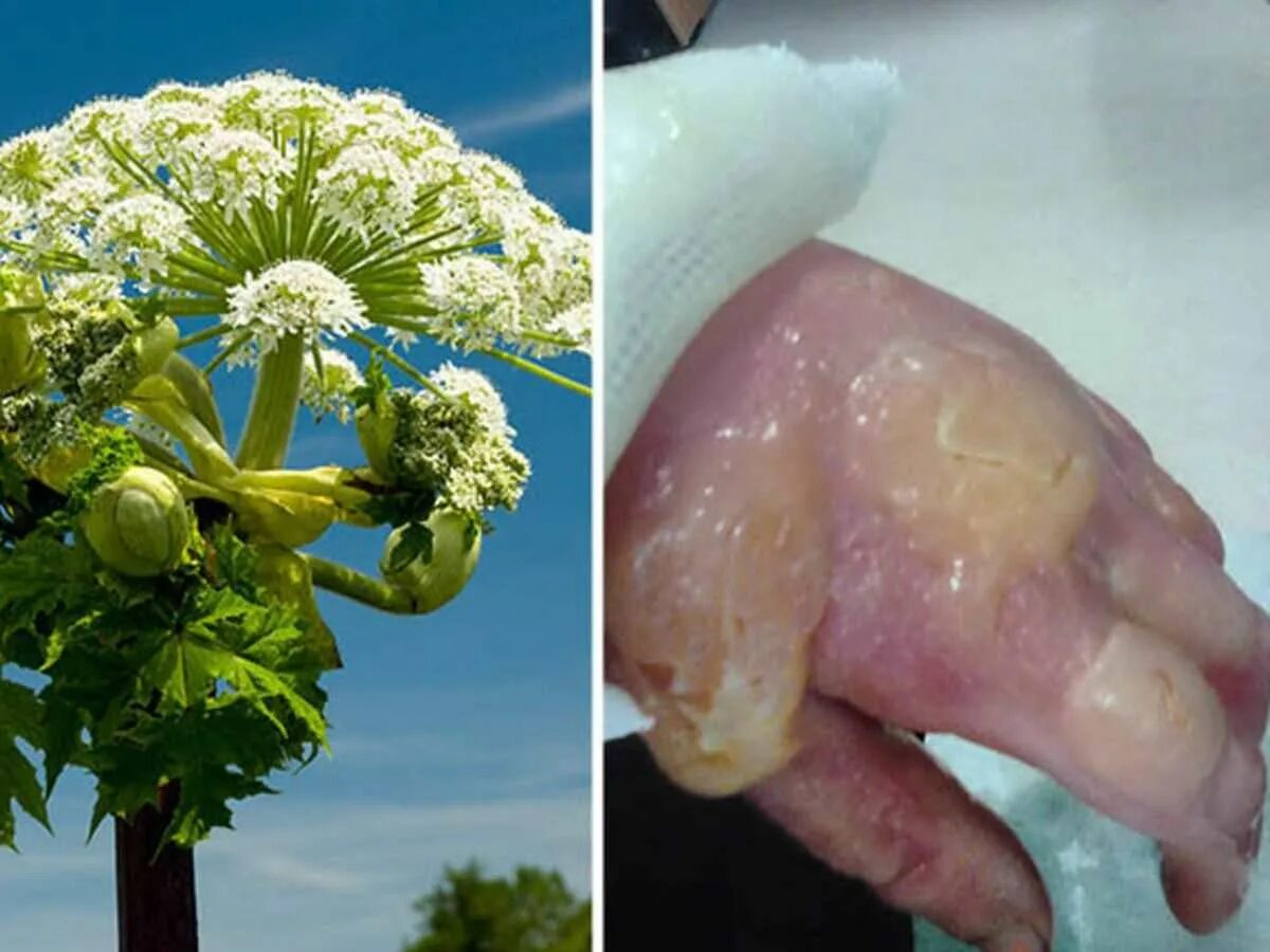 Борщевик сосновского волдыри. Борщевик 3 метра. Борщевик можно есть. Ядовитый борщевик сосновского. Борщевик сосновского ожоги.