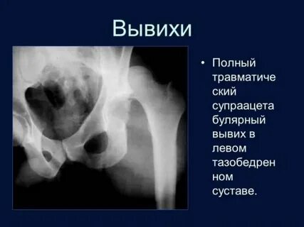 Полный вывих