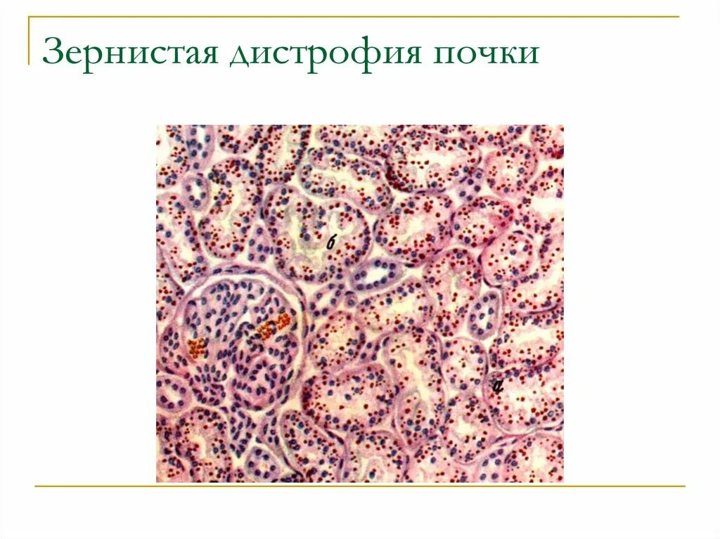 Гидропическая дистрофия эпителия канальцев почки. Зернистая дистрофия эпителия почечных канальцев. Зернистая дистрофия почек микропрепарат. Гидропическая дистрофия почки макропрепарат. Белковые канальцы