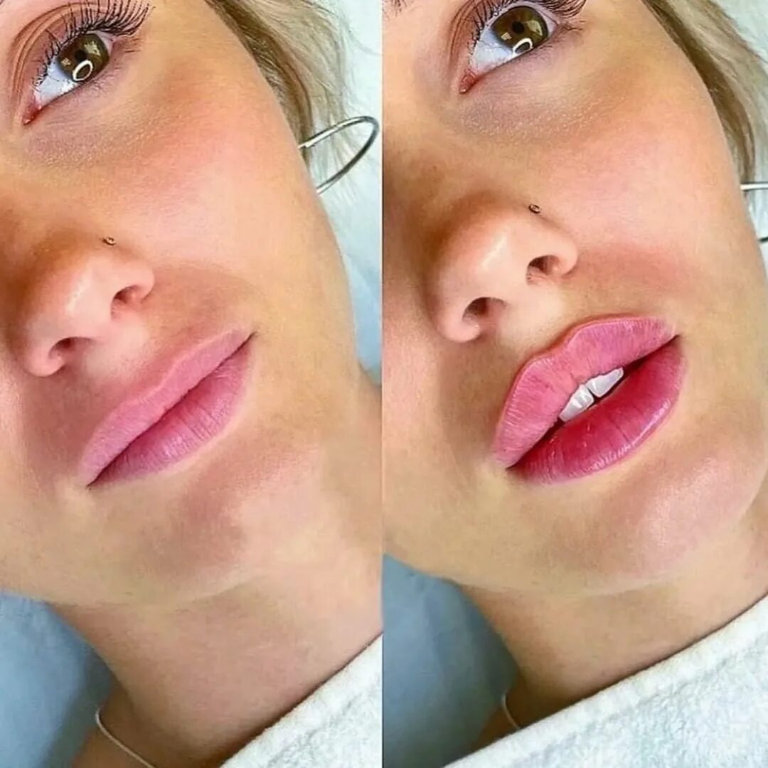 губы после гиалуроновой кислоты. гиалуроновая кислота в губы. контур губ гиалуроновой кислотой 1 мл. контурная пластика 0. реальные фото у косметолога губы.