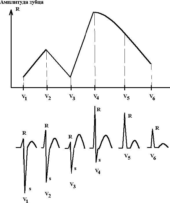 Зубцы в грудных отведениях. Зубец r в грудных отведениях. Нарастание зубца r в v1-v3. Отсутствие зубца r в грудных отведениях.