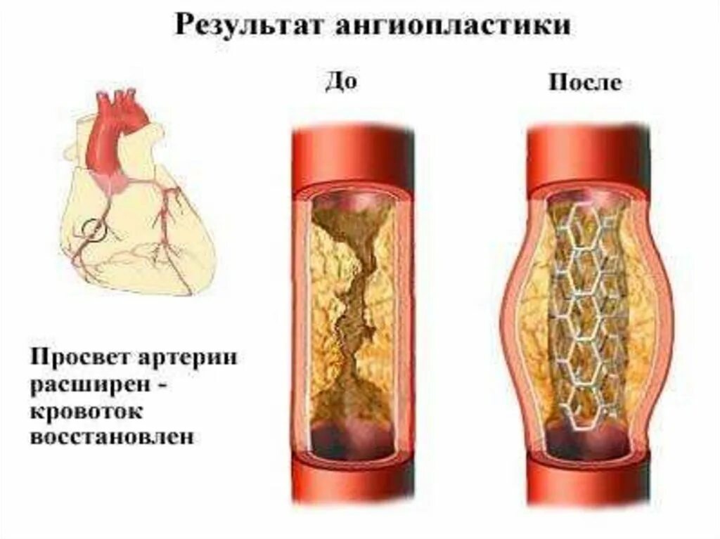 Операция стенд сосуды. Стентирование коронарных сосудов. операция стентирование сосудов сердца. коронарная ангиопластика и стентирование. баллонопластика сосудов сердца.