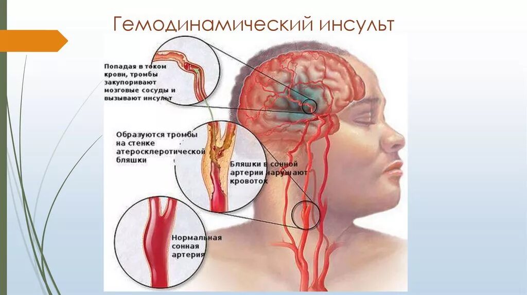 Микроангиопатия головного мозга симптомы