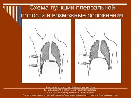 Прокол при пневмотораксе