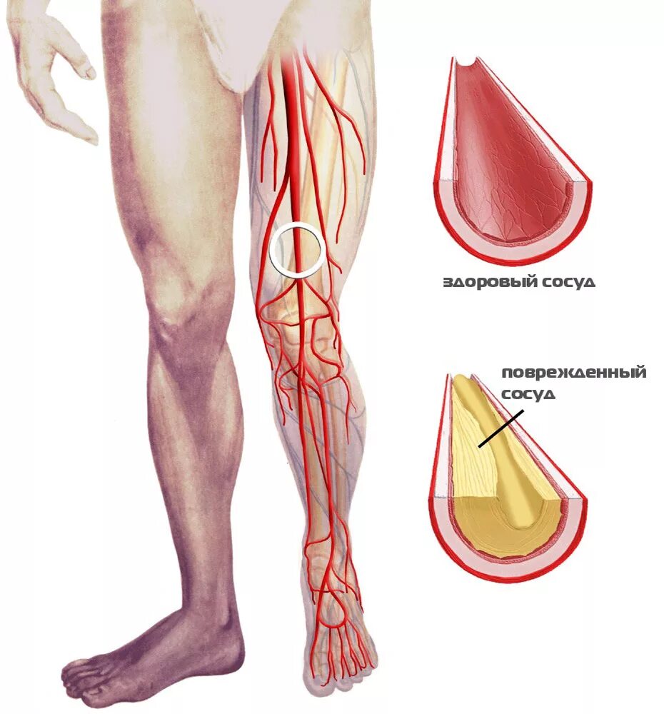 Облитерирующий атеросклероз сосудов конечностей. Облитерирующий атеросклероз вен нижних конечностей. Облитерирующий атеросклероз сосудов нижних. Облитерирующий атеросклероз артерий нижних конечностей ноги. Тромбоз артерий лечение