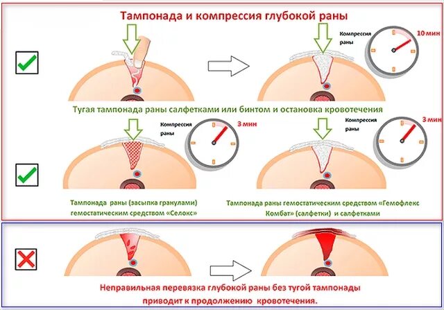 Тампонада раны при кровотечении. Тугая тампонада раны остановки кровотечения. Тампонада раны при кровотечении алгоритм действий. Остановка кровотечения методом тампонады раны. Тампонада раны при артериальном кровотечении.