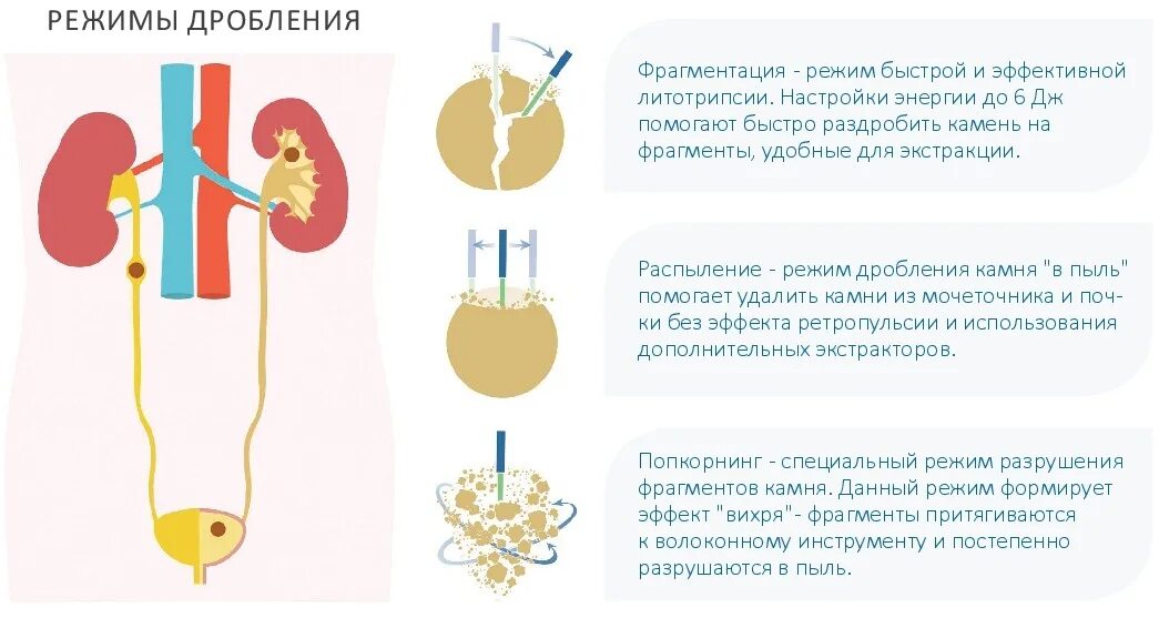 Как дробят камни лазером. Дробление камней в мочеточнике лазером. режимы дробления. стенды для дробления камней.