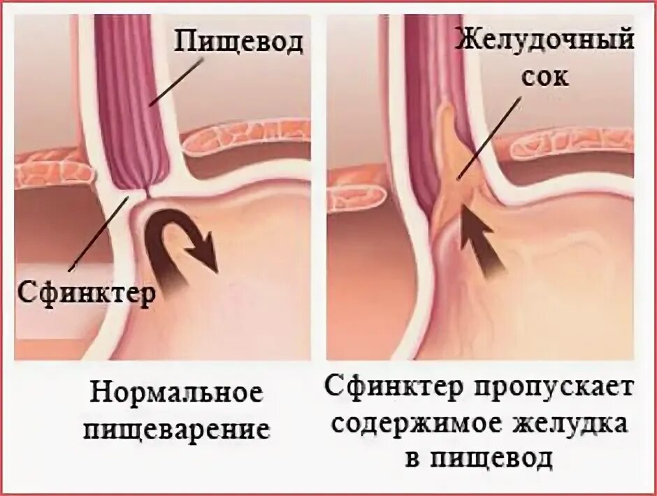 Как лечить сфинктер. Недостаточность нижнего пищеводного сфинктера симптомы. нижни пещеводны сфинктер. сфинктеры желудка и пищевода. верхний пищеводный сфинктер.