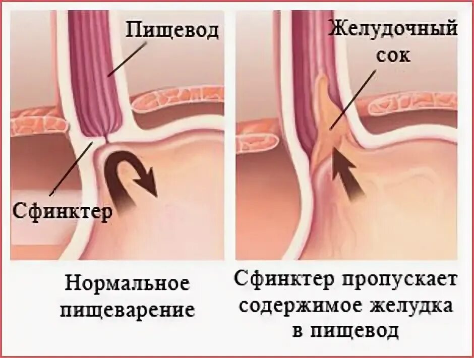 Недостаточность кардии ГЭРБ. Недостаточность Нижнего пищеводного сфинктера симптомы. Нижний сфинктер пищевода. Пищеводный сфинктер желудка. Несмыкание кардии желудка