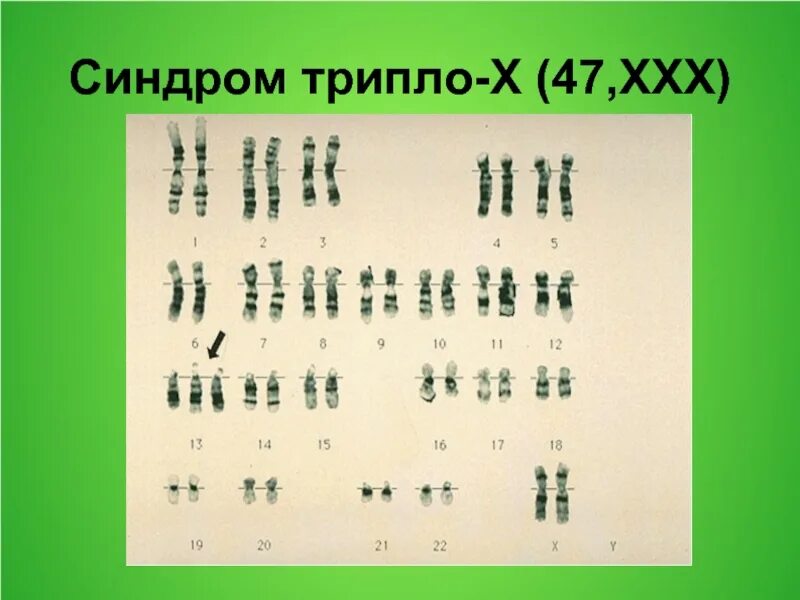 Синдром трисомии х кариотип. Синдром трипло-х. Трипло х кариотип. Трисомия по х-хромосоме кариотип. Фото трипло