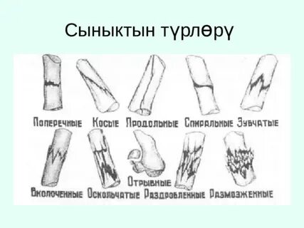 Переломы поперечные косые