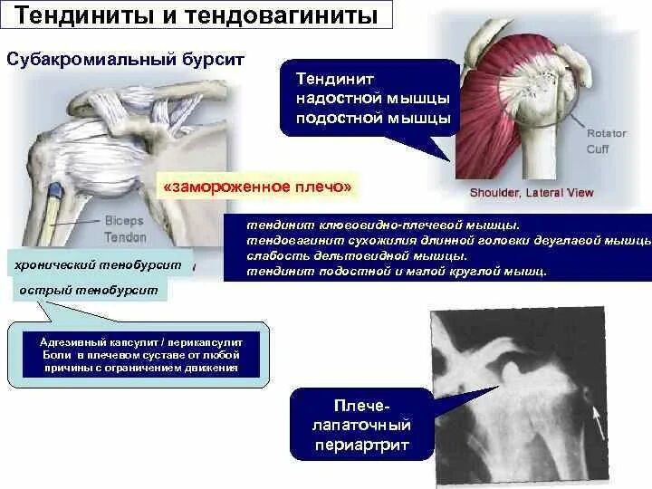 Тендинит сухожилия надостной. Тендовагинит сухожилия надостной мышцы плечевого сустава. Тендинит сухожилия ротаторной манжеты плечевого сустава. Субакромиальная Бурса.
