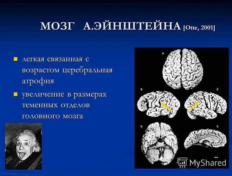 Атрофия головного мозга на кт. Мозжечковая дегенерация мрт. Кортикальная атрофия головного мозга. Мозжечковая дегенерация мрт. Кортикальная церебральная атрофия 1 ст что это.