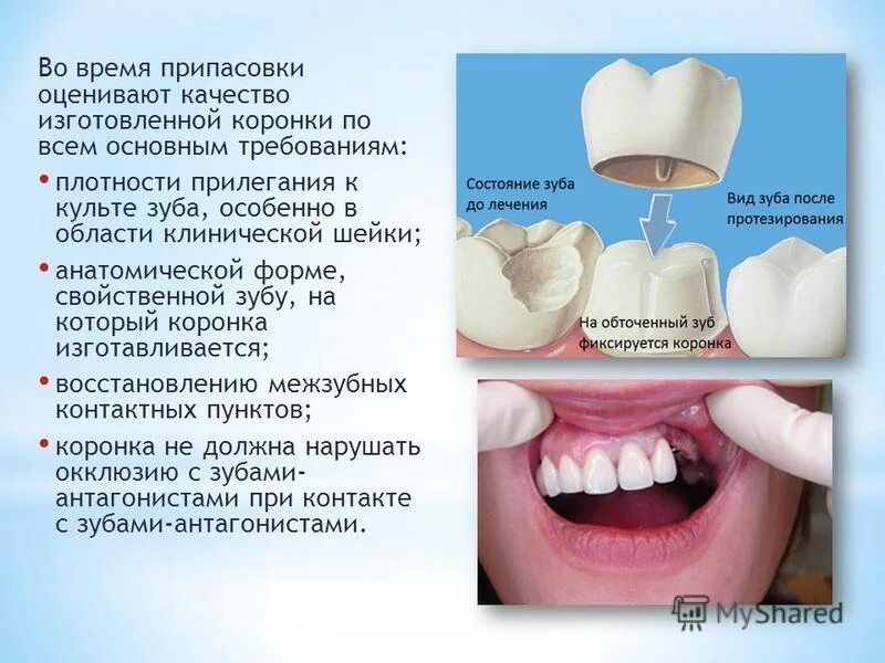 Сколько изготавливается коронка. Фиксация металлических коронок. Пластмассовые коронки презентация. Припасовка пластмассовой коронки. Пластиковые зубные коронки.