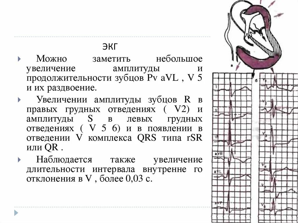 Расщепление зубца. Расщепленный зубец r в avl. расщепленный зубец r на экг в 2 отведении. раздвоение и увеличение амплитуды зубца р. повышение амплитуды зубца r экг.