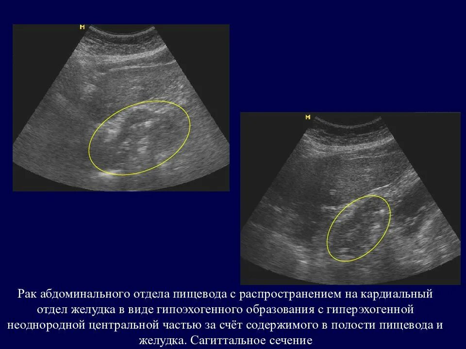 Гипоэхогенное округлое образование. Гипоэхогенное образование в паренхиме почки. Гиперэхогенные включения в печени. Гипоэхогенные образования в кишечнике. Гипоэхогенное неоднородное образование.