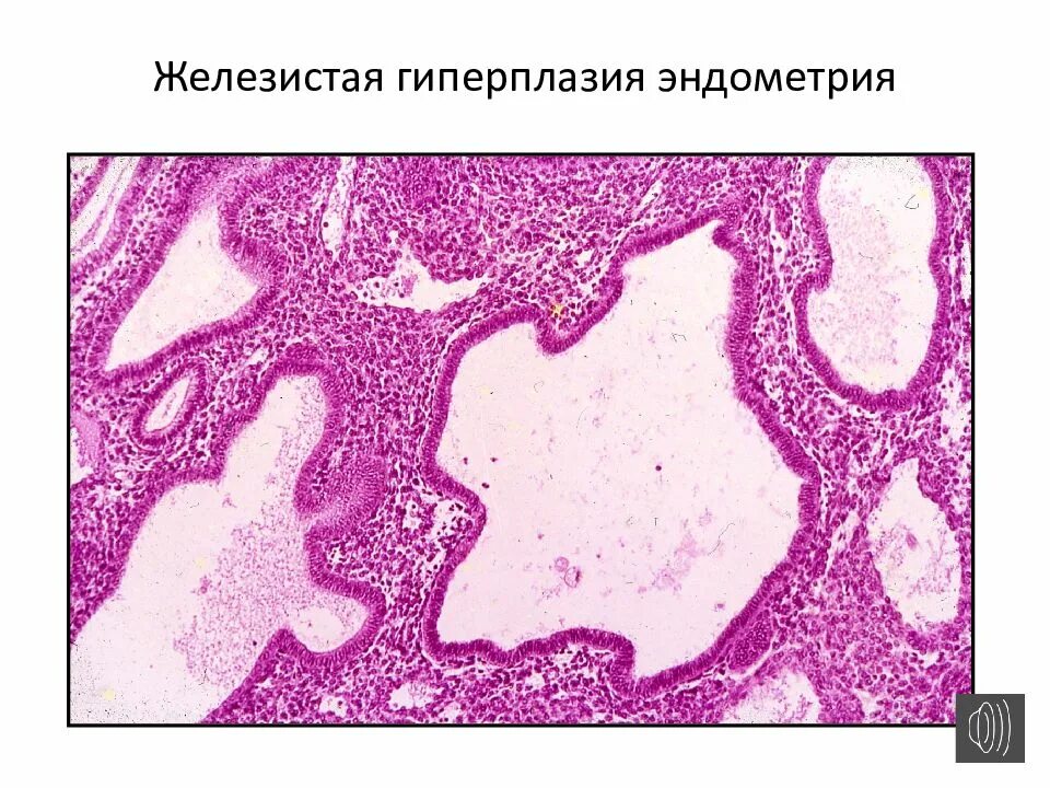 Железо и эндометрий. Гиперплазия эндометрия микроскопия. Простая гиперплазия эндометрия гистология. Неатипическая железистая гиперплазия. Гиперплазия матки гистология.