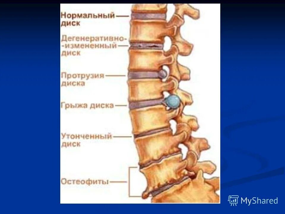 Втэс отзывы. Внутритканевая электростимуляция позвоночника. Внутритканевая электростимуляция по Герасимову (ВТЭС). Электростимуляция позвоночника. ВТЭС шейного отдела позвоночника.