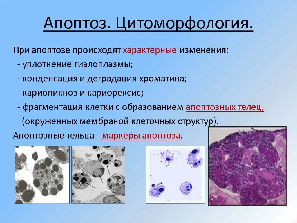 Апоптоз клетки микроскоп. Кариорексис кариолизис. Апоптозные тельца. Апоптоз конденсация хроматина.