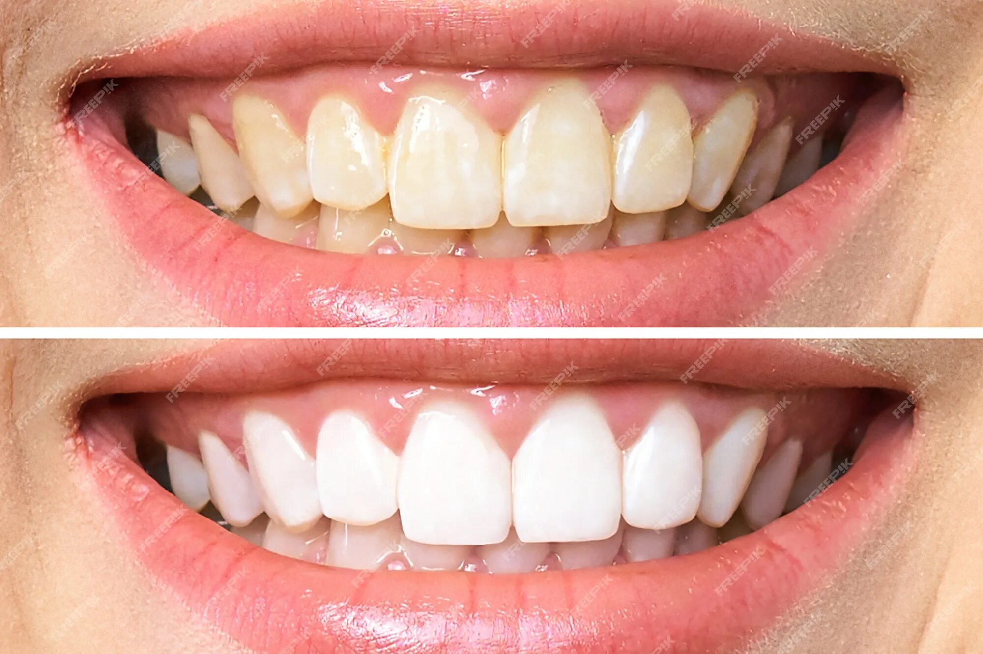 Пить после отбеливания зубов. Отбеливание зубов амазинг Вайт. Зубы до и после отбеливания. Отбеливание зубов до и после. Красивые белоснежные зубы до и после.