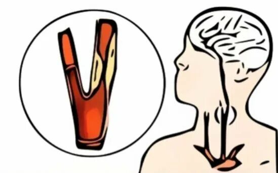 Атеросклеротические изменения брахиоцефальных артерий. Атеросклеротические изменения брахиоцефальных артерий