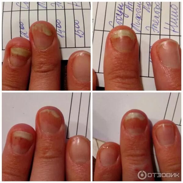 Клавио для ногтей при онихолизисе. Клавио лосьон для ногтей от онихолизиса. Тербинафин онихолизис.